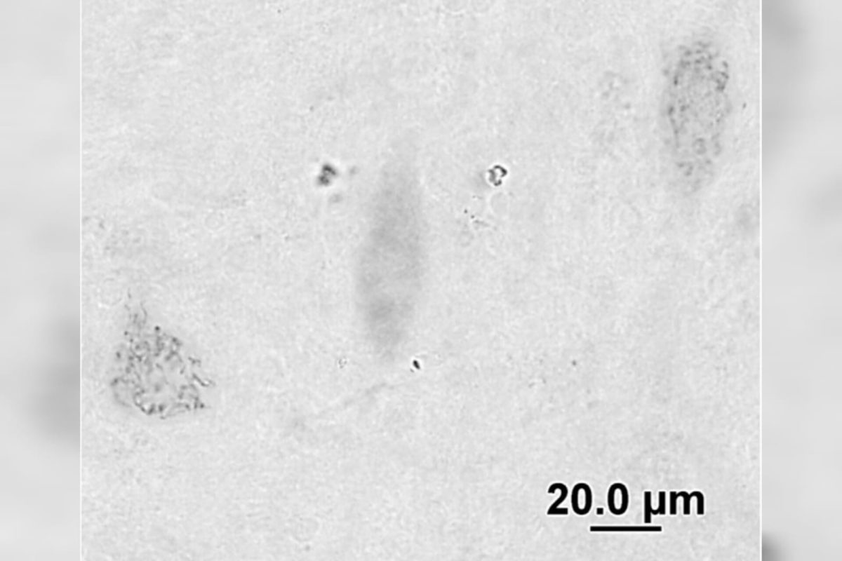 Alzheimer neuronios com granulos 1200x800