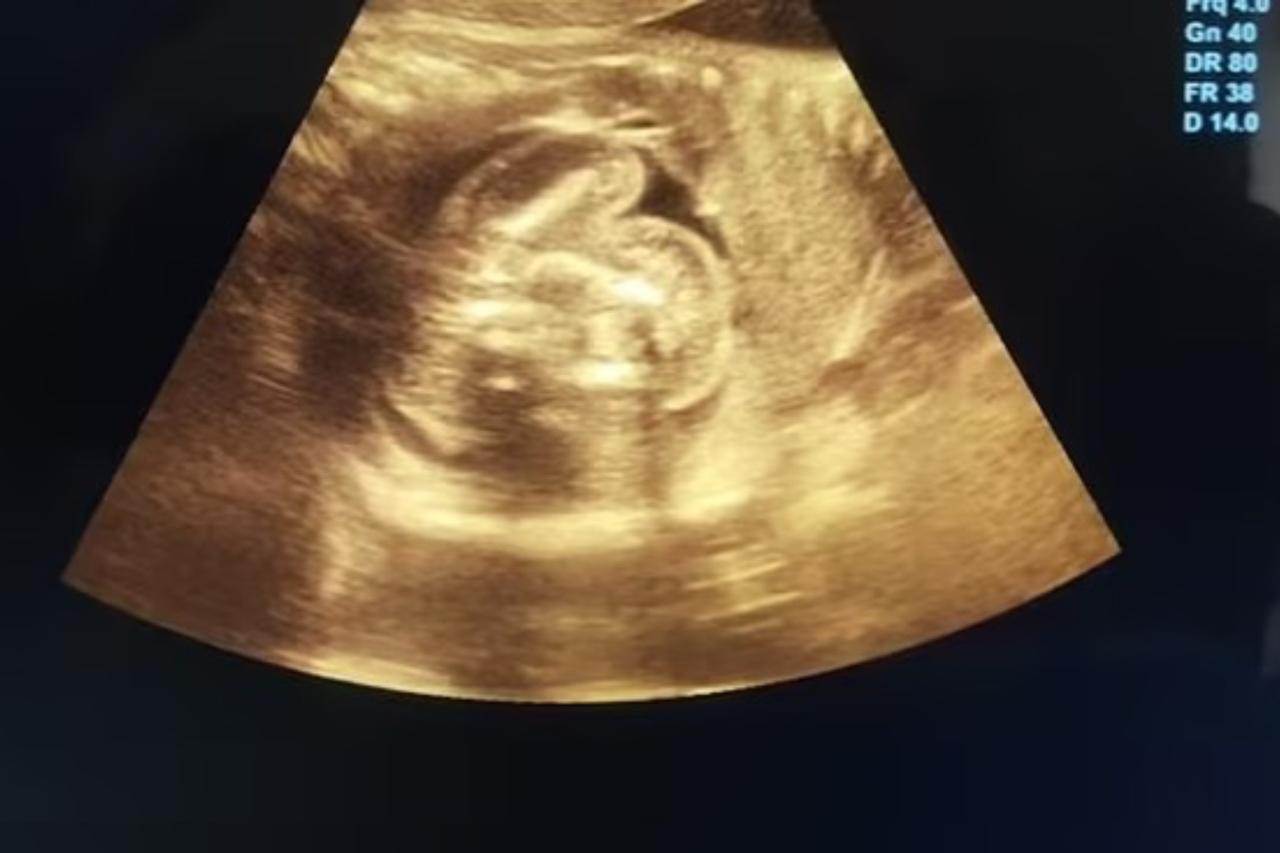 Bebe Nasce Com Dois Fetos Dentro Da Barriga 2