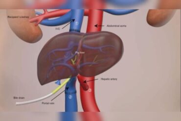 Figado de porco e transplantado em paciente humano pela primeira vez 2 e1743082008566