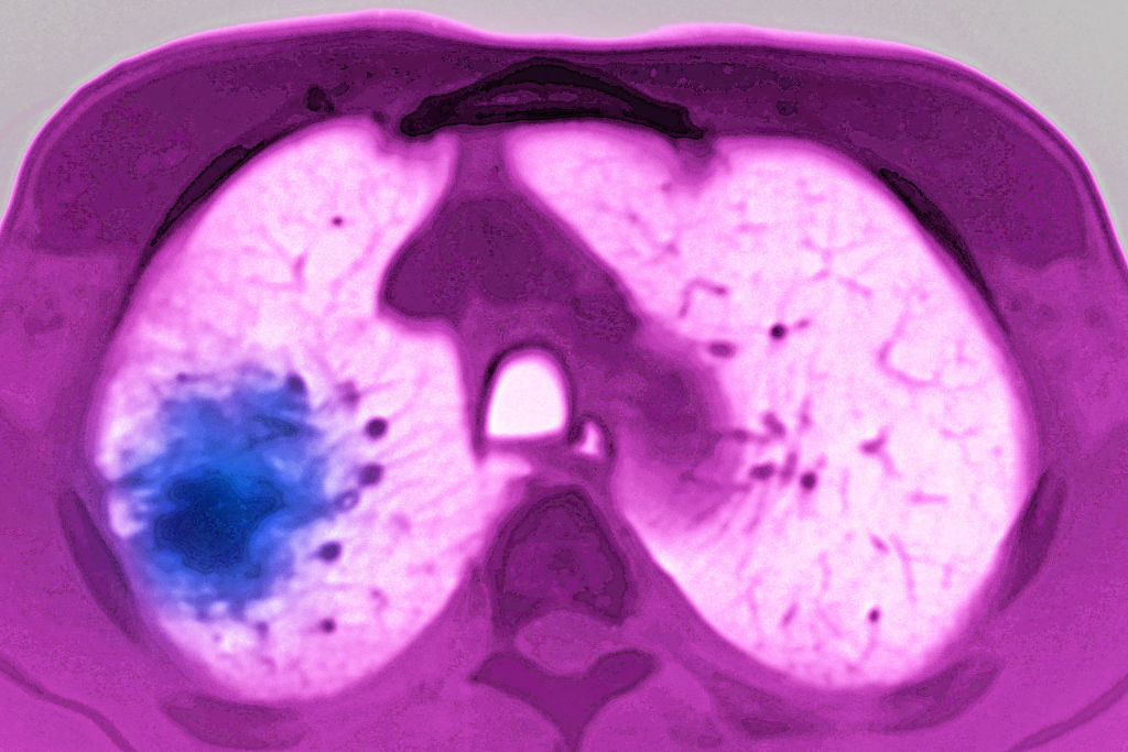 Especial cancer no pulmao