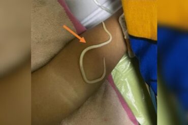 Menino vomita vermes horas depois de ser diagnosticado com constipacao 3 e1744490767690