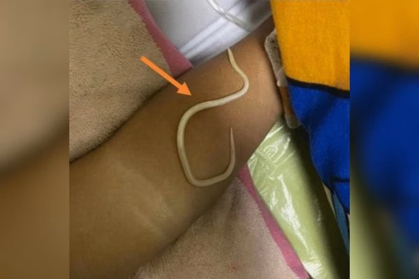 Menino vomita vermes horas depois de ser diagnosticado com constipacao 3 e1744490767690
