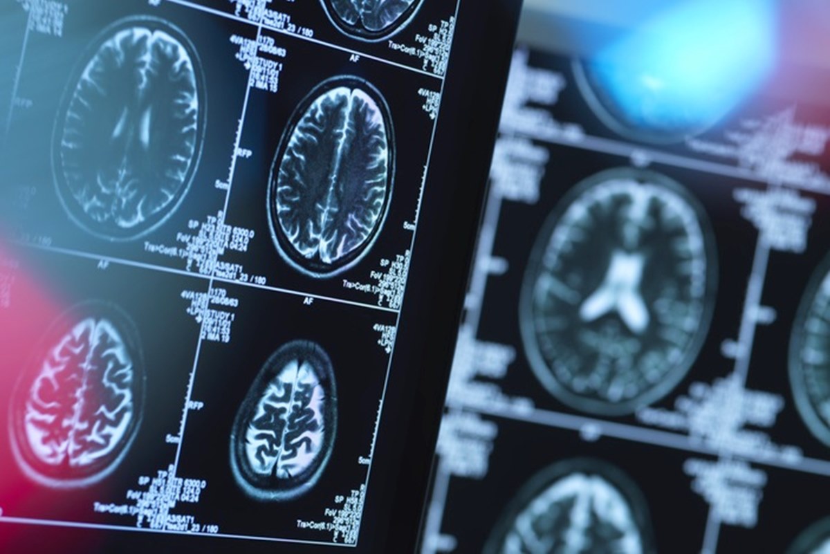 Cerebro e demencia