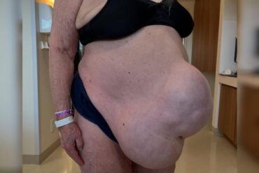 Hernia abdominal 13 anos paciente cirurgia 1