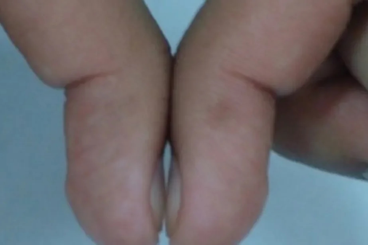 Teste unhas para perceber risco de cancer