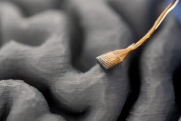 Chip no cerebro implante permite que homem volte a falar 2