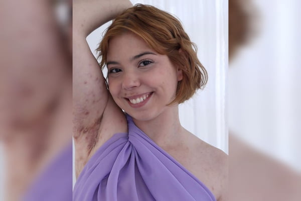 Hidradenite lupus psoriase doencas cronicas