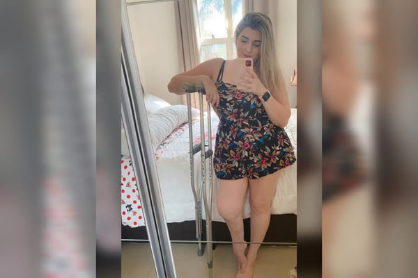 Mulher perna amputada por fratura aos 4 anos