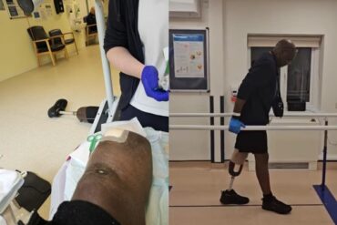 Homem tem perna amputada apos tratar queimadura em casa 2