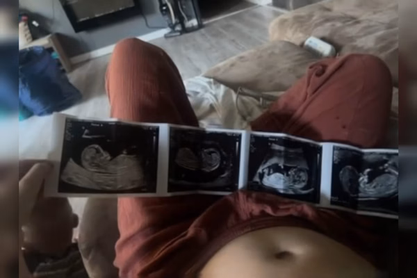 Mulher gravida de quintuplos acaba tendo que escolher quais fetos retirar 3