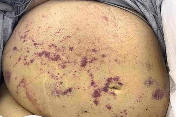 Infeccao por vermes eua