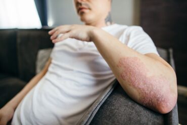 Psoriase 2