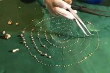 Cirurgia na india remove 526 dentes da boca de um menino de sete anos 1 e1756305416365