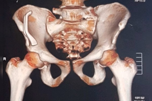 Jovem ficou com acionador de freio de bicicleta preso em seu quadril por meses 1