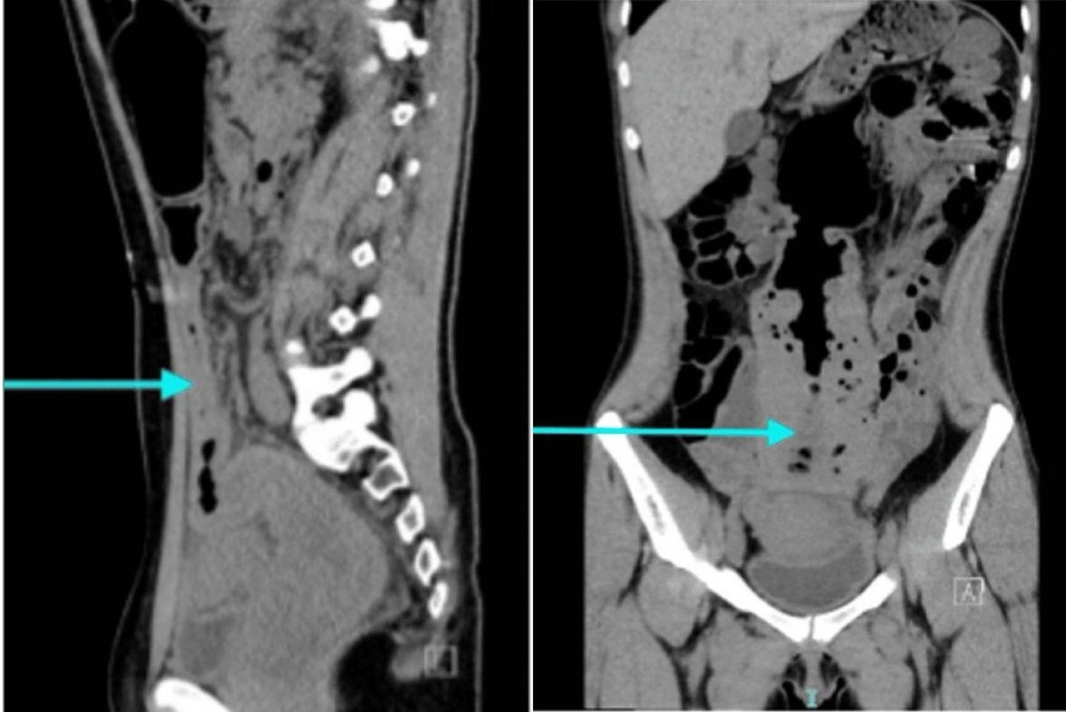 Mulher passa quatro meses constipada e perde 45 kg apos tratamento depois