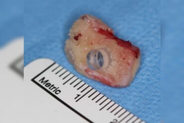 Foto lente de contato no dente cirurgia no olho recuperacao da visao 1