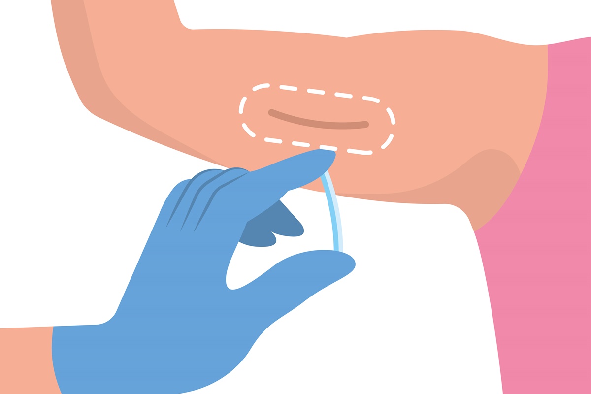 Como colocar implanon