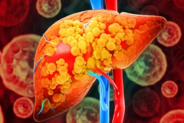 Gordura no figado 4 4