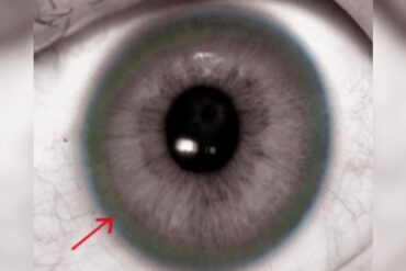 Doenca de wilson materia