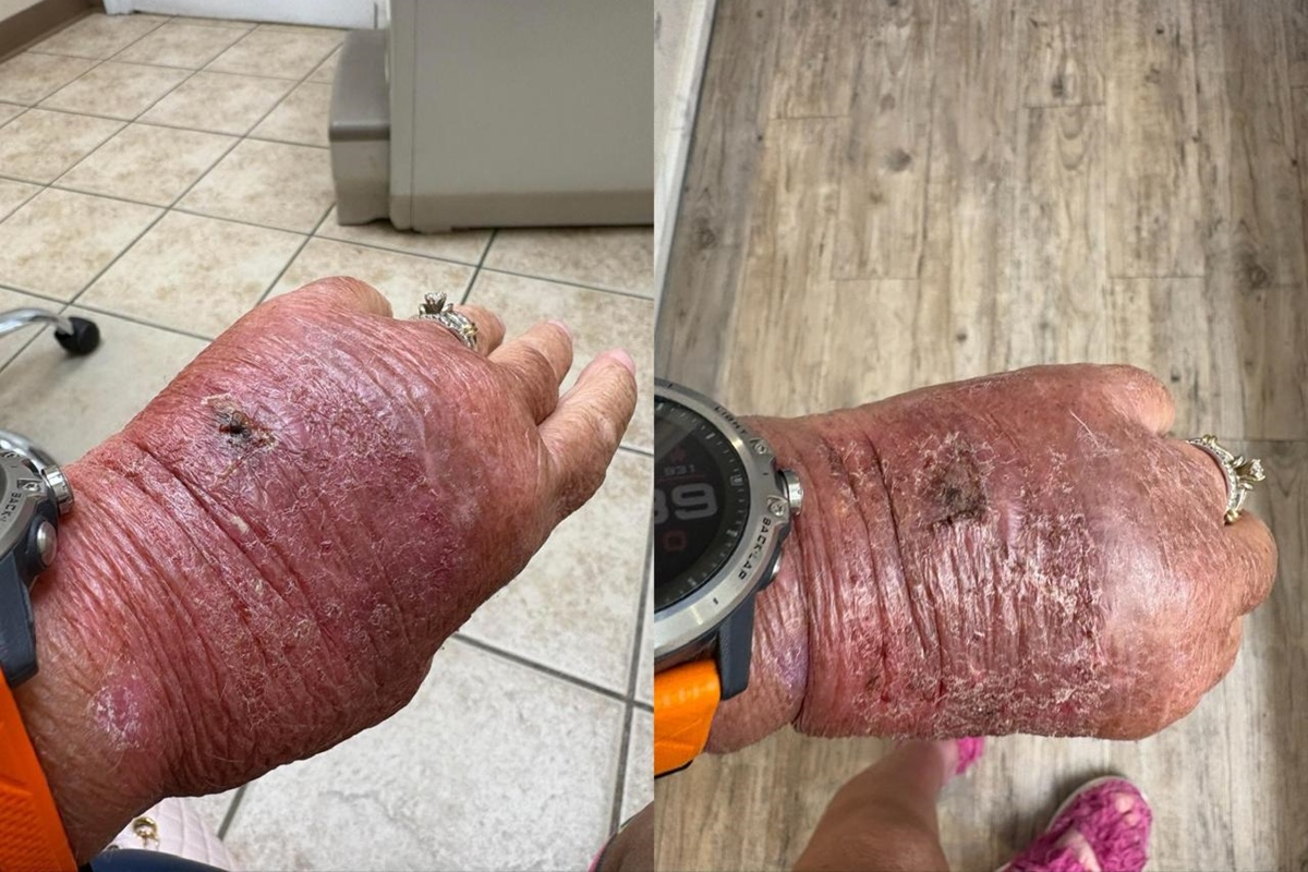 Corte com papelao infecciona e leva mulher de 63 anos ao hospital 2