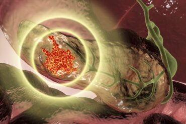 Ilustracao cancer no pancreas