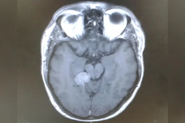 Homem convive com zumbido por 2 anos e descobre tumor cerebral 3